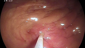 Subfertility_Catheter Placed Within Uterine Tube Papilla